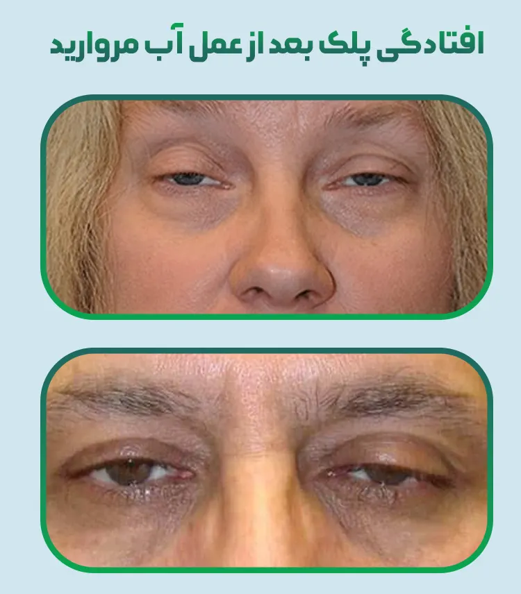 افتادگی پلک بعد از عمل آب مروارید