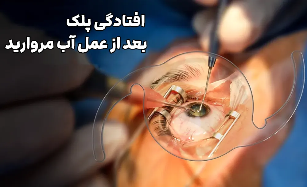 عمل آب مروارید