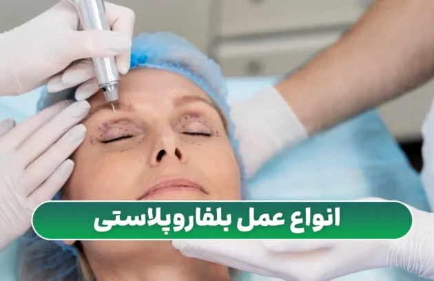 انواع عمل بلفارو