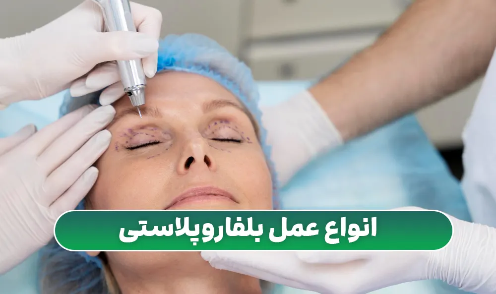 انواع عمل بلفارو