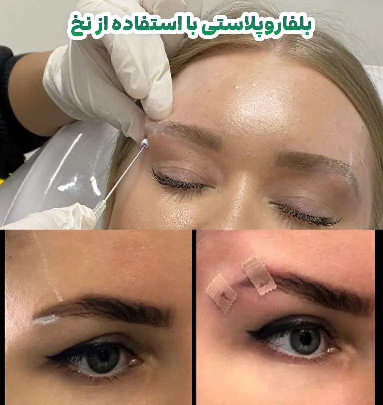 بلفاروپلاستی با استفاده از نخ