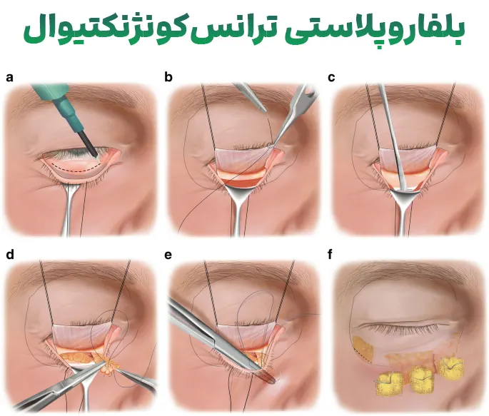 بلفاروپلاستی ترانس‌کونژنکتیوال