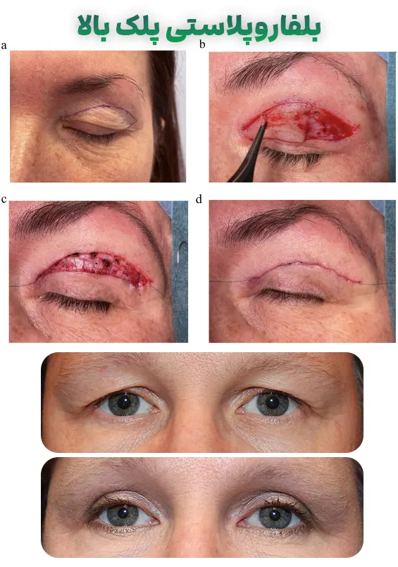 بلفاروپلاستی پلک بالا
