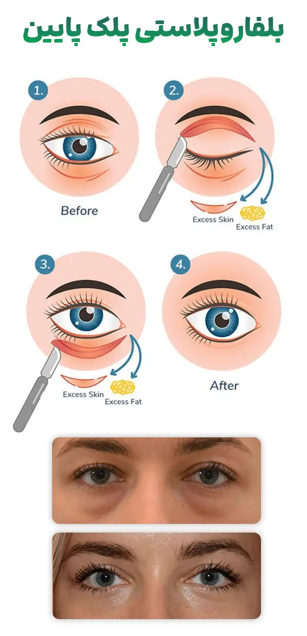 بلفاروپلاستی پلک پایین