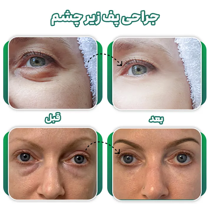 جراحی پف زیر چشم