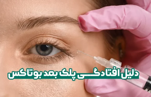 دلیل افتادگی پلک بعد بوتاکس و درمان آن