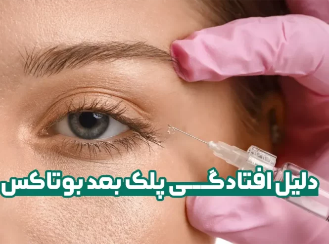 دلیل افتادگی پلک بعد بوتاکس و درمان آن