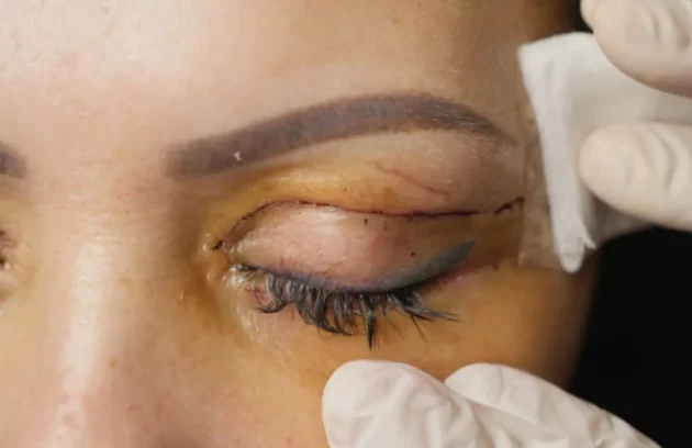 بهترین درمان ها برای رد بخیه بلفاروپلاستی