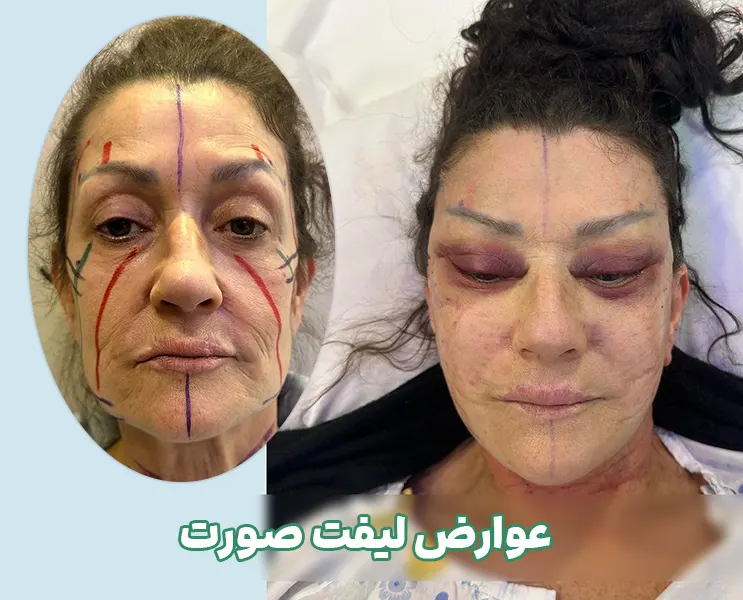 عوارض لیفت اندوسکوپیک شقیقه