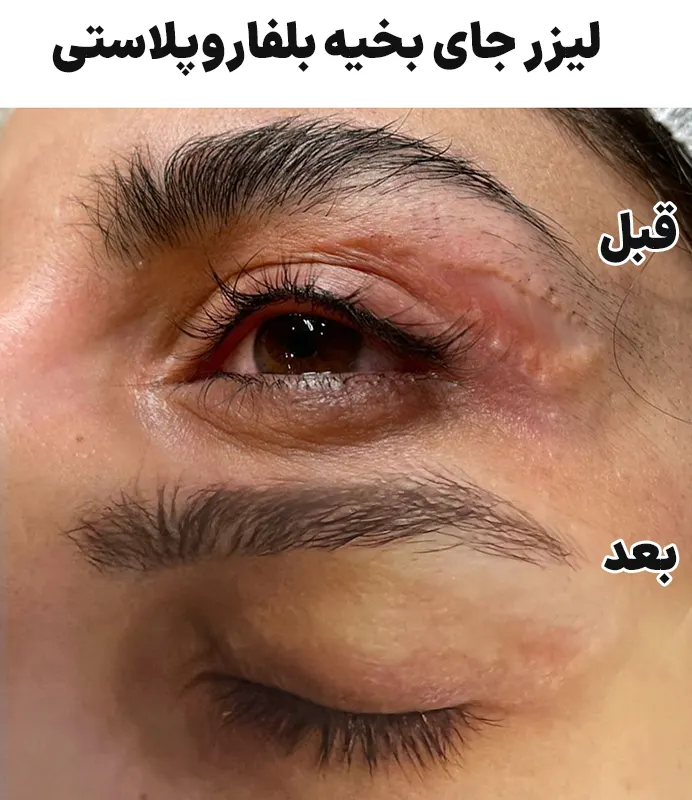 قبل و بعد لیزر جای بخیه بلفاروپلاستی