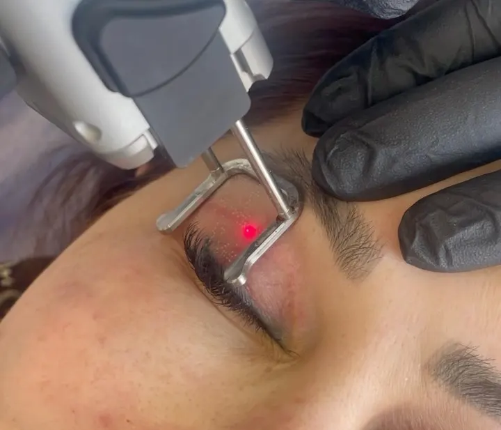 لیزر جای بخیه بلفاروپلاستی