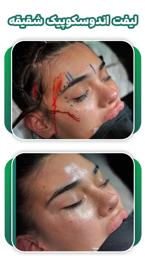 لیفت اندوسکوپیک شقیقه