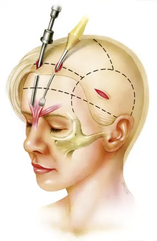 لیفت اندوسکوپیک شقیقه