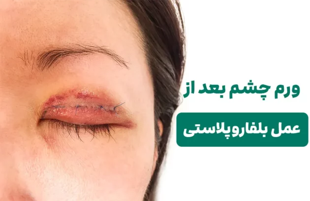 ورم چشم بعد از عمل بلفاروپلاستی