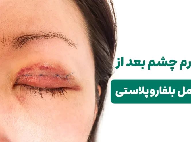 ورم چشم بعد از عمل بلفاروپلاستی
