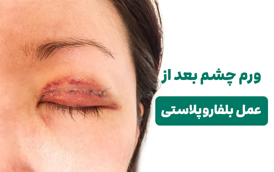 ورم چشم بعد از عمل بلفاروپلاستی