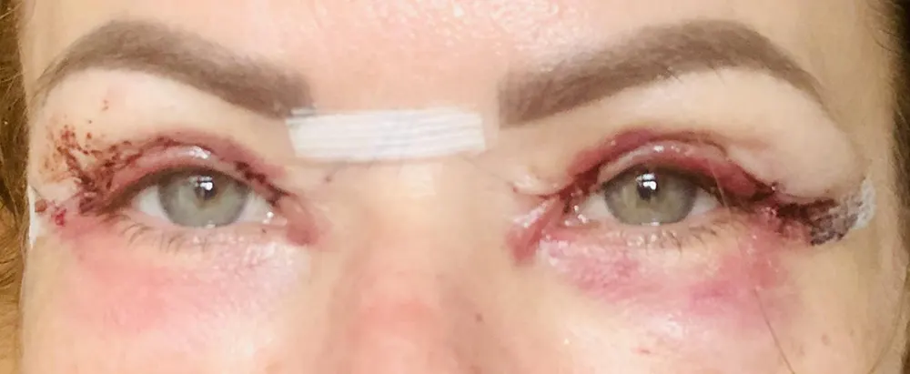 ورم چشم بعد از عمل بلفاروپلاستی