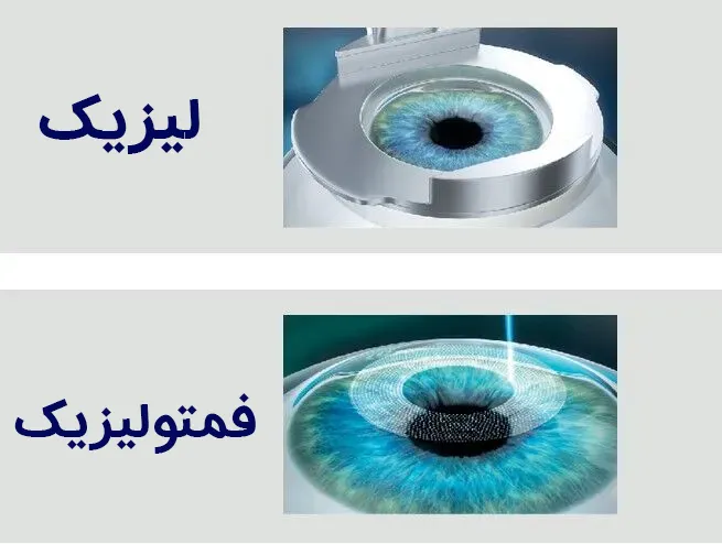 لیزیک و فمتولیزیک