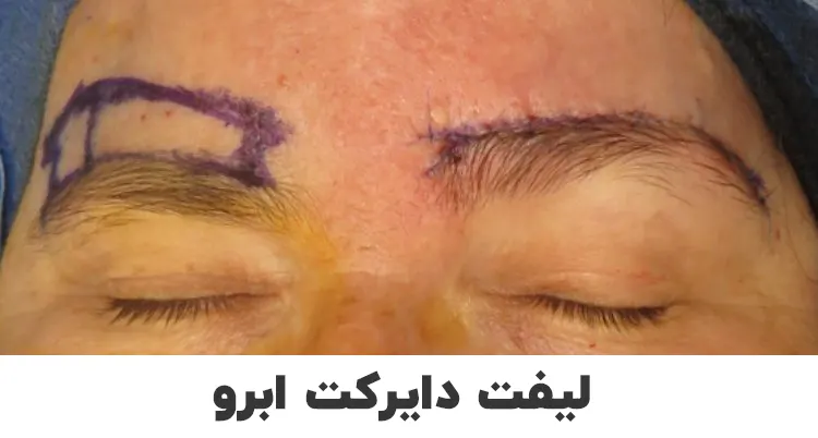 لیفت دایرکت ابرو