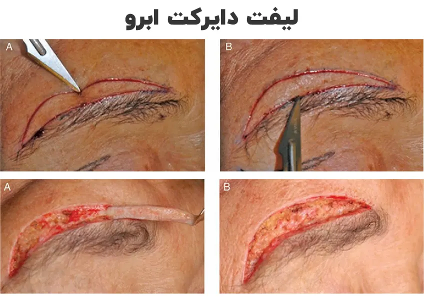 لیفت دایرکت ابرو