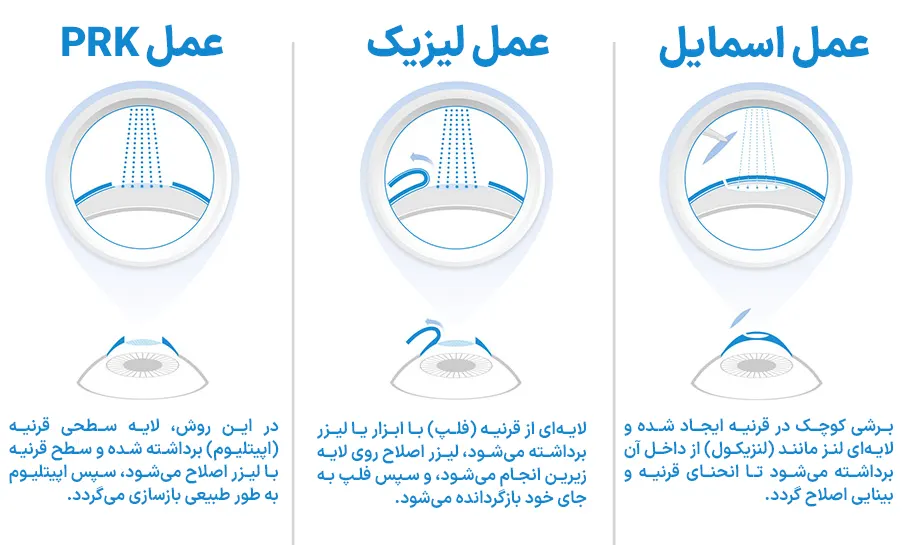 مقایسه اسمایل لیزیک prk