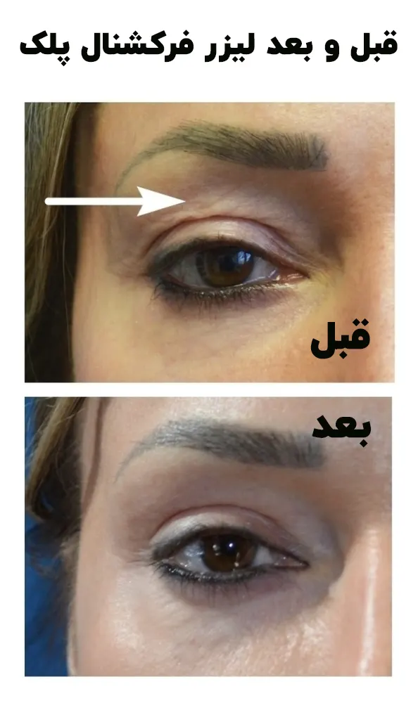 قبل و بعد لیزر فرکشنال پلک