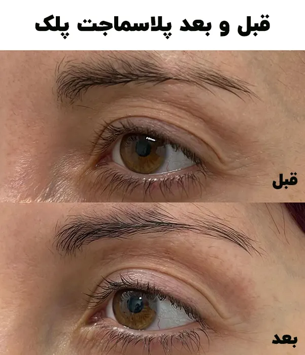 قبل و بعد پلاسماجت پلک