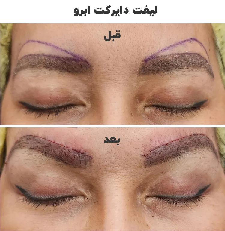 لیفت دایرکت ابرو