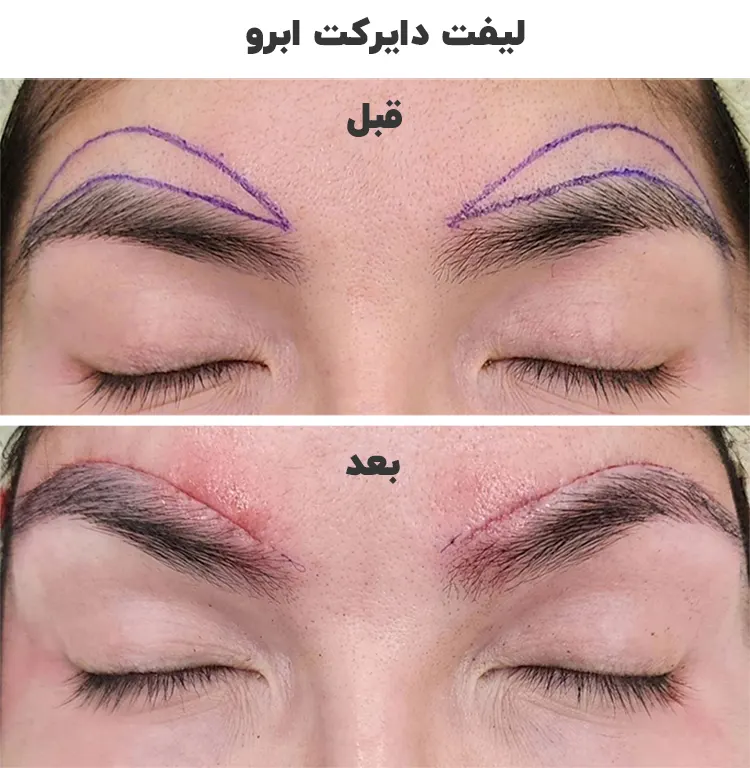 لیفت دایرکت ابرو