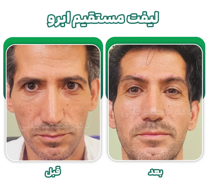 لیفت دایرکت ابرو