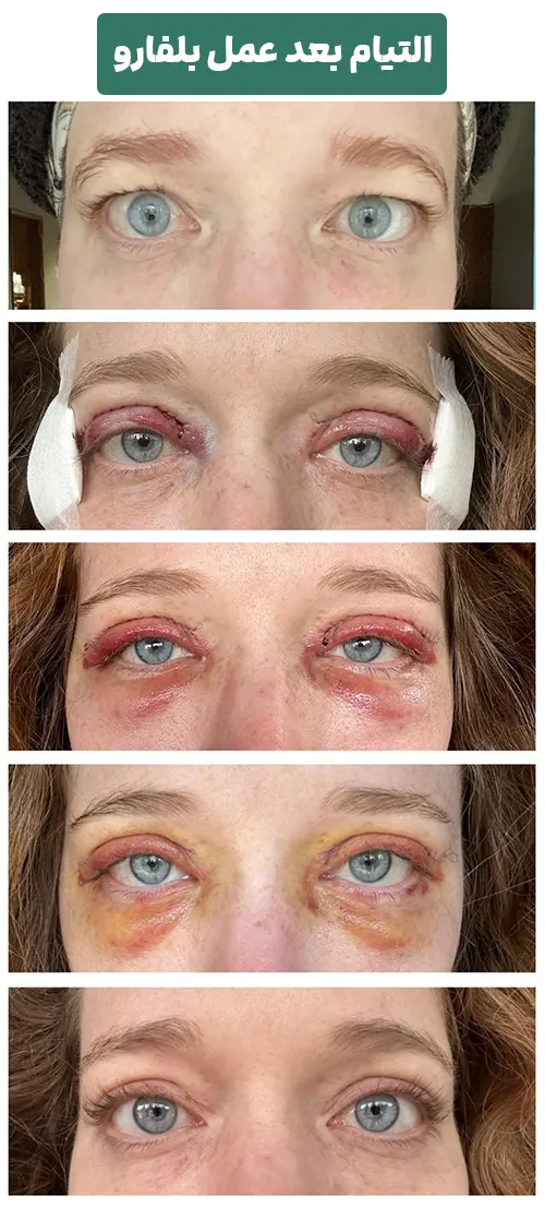 مراحل درمان ورم چشم بعد بلفارو