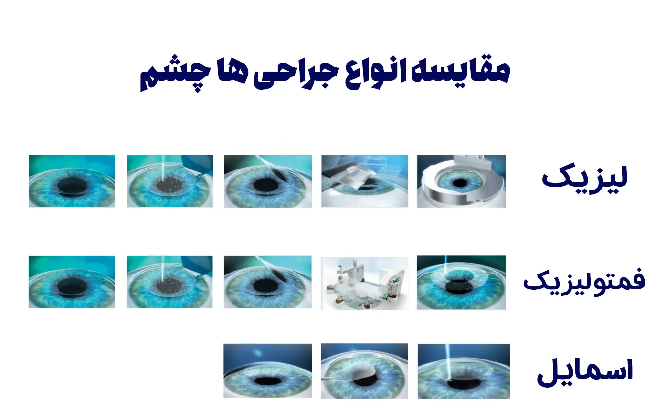 مقایسه انواع جراحی چشم