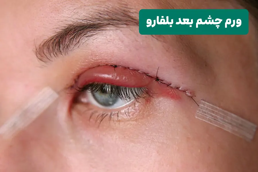 ورم چشم بعد از عمل بلفاروپلاستی