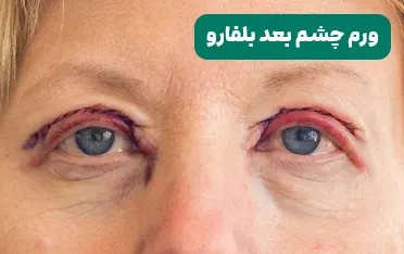 ورم چشم بعد از عمل بلفاروپلاستی