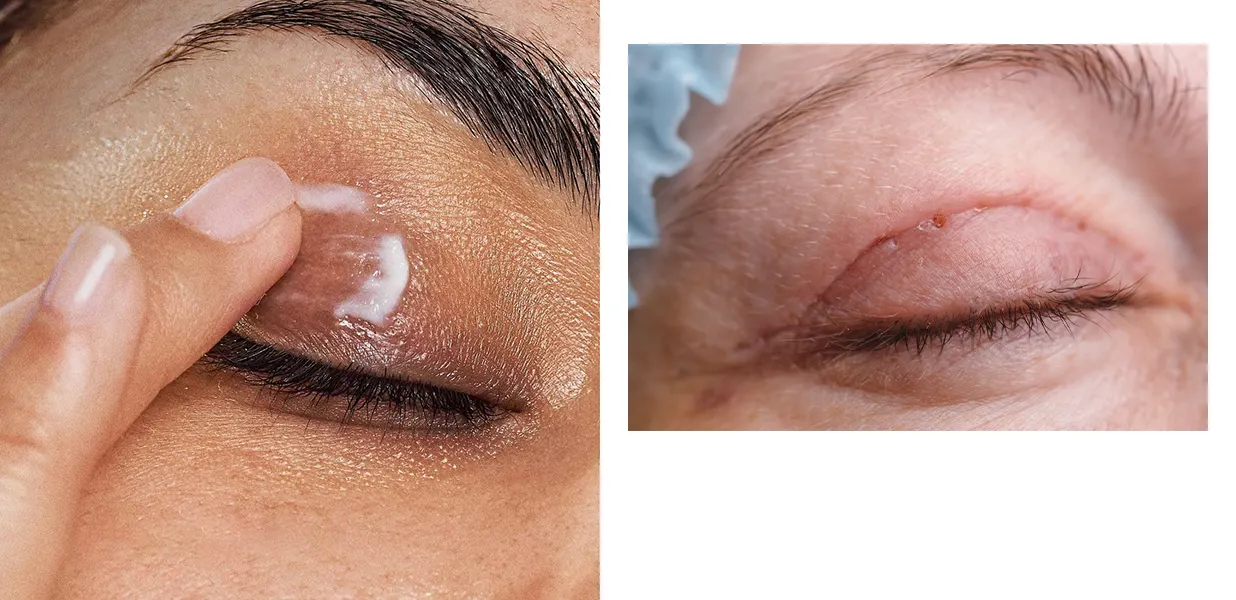 ترمیم کننده بعد عمل بلفاروپلاستی