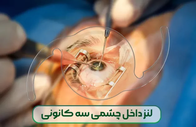 لنز داخل چشمی سه کانونی