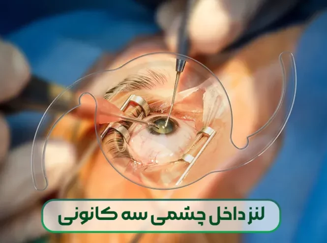 لنز داخل چشمی سه کانونی