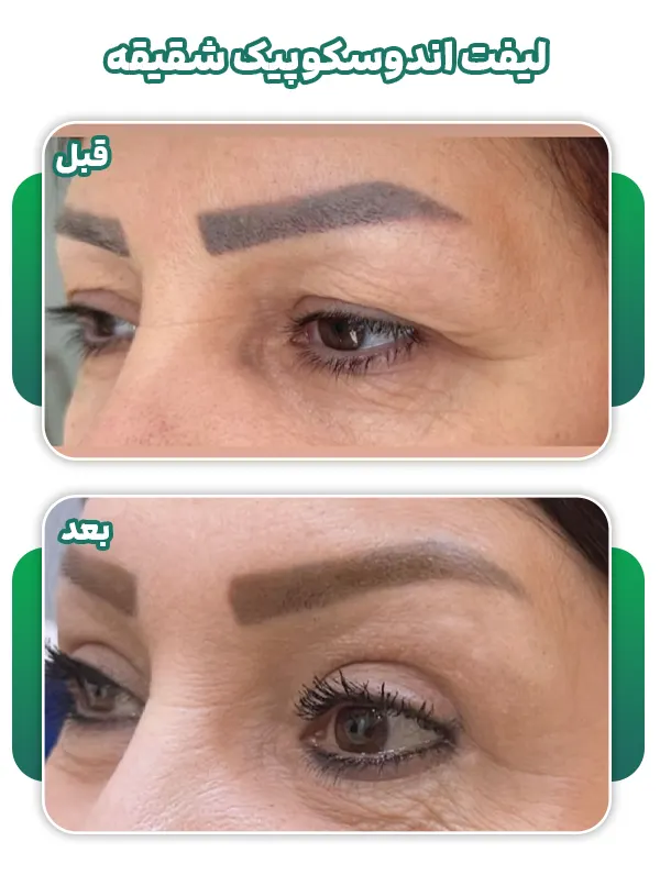 لیفت اندوسکوپیک شقیقه قبل بعد