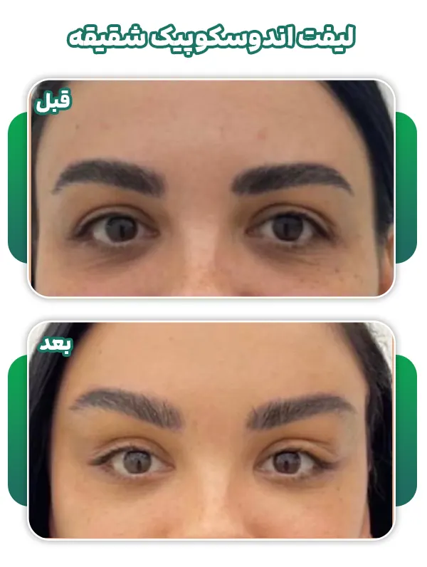 قبل بعد لیفت اندوسکوپیک شقیقه