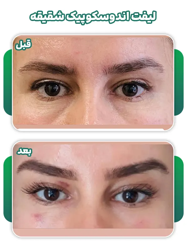 عکس لیفت اندوسکوپیک شقیقه