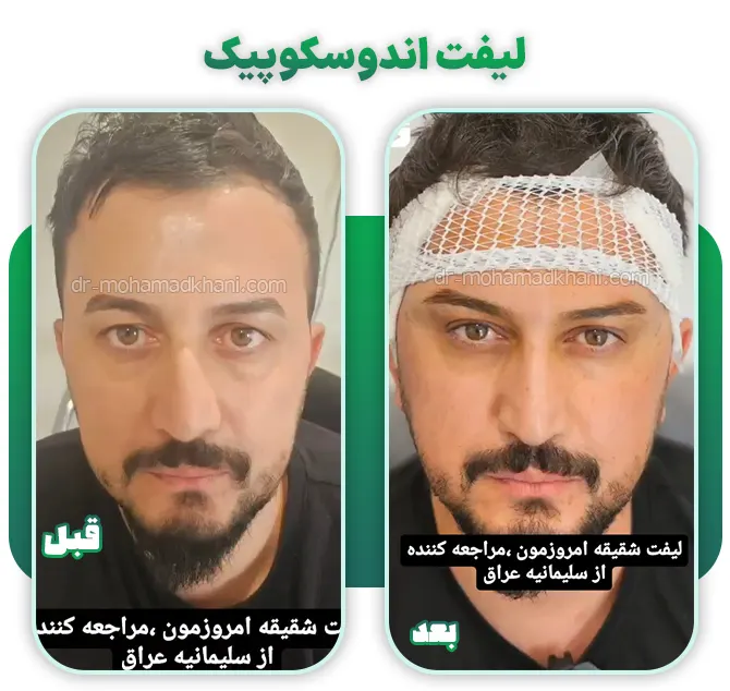 لیفت اندوسکوپیک شقیقه