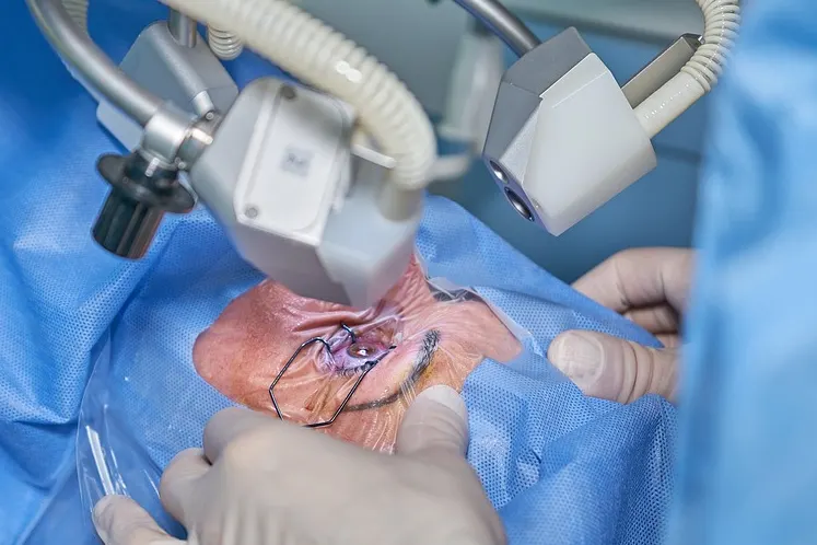 عمل لیزیک چشم