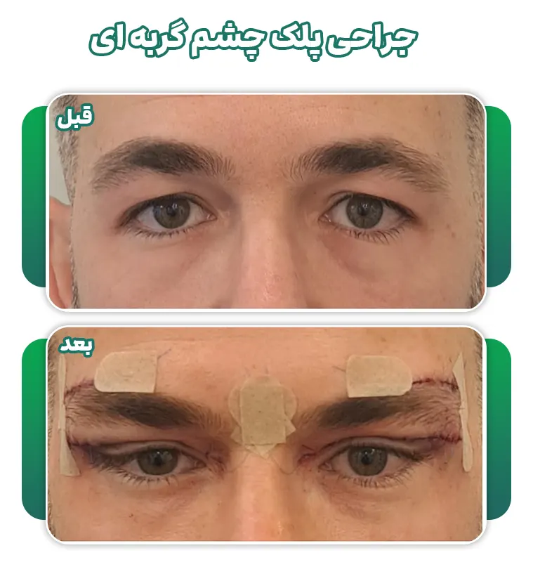 جراحی پلک چشم گربه ای