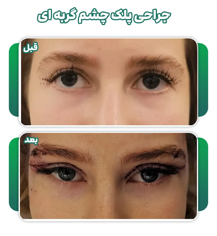 جراحی پلک چشم گربه ای