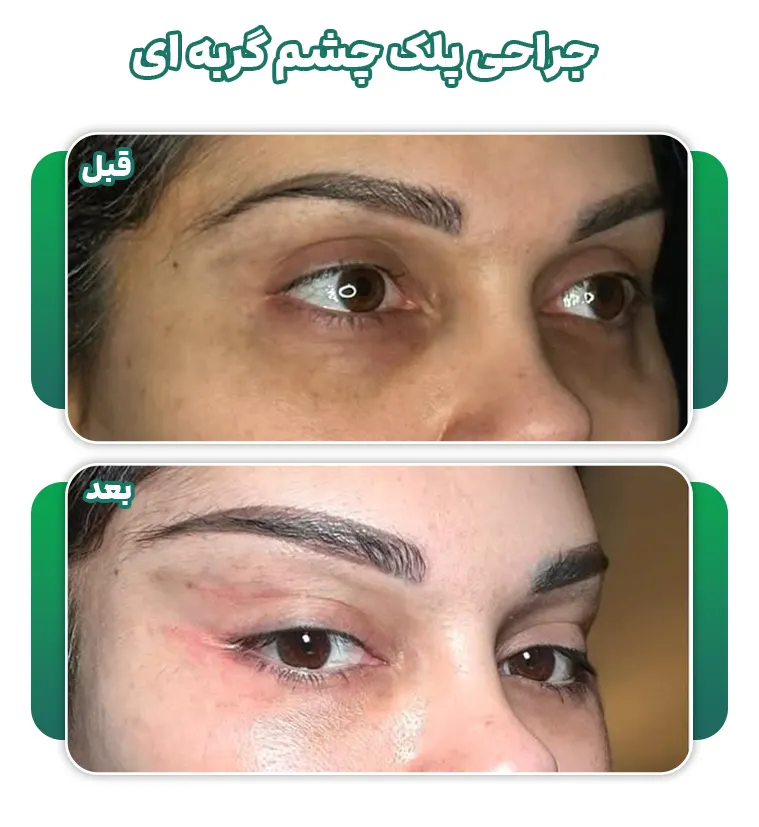 جراحی پلک چشم گربه ای