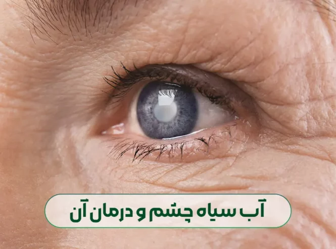 آب سیاه چشم و درمان آن