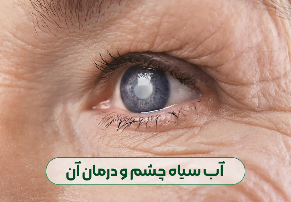 آب سیاه چشم و درمان آن