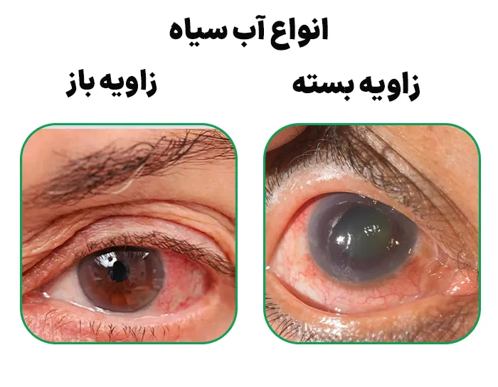 انواع آب سیاه