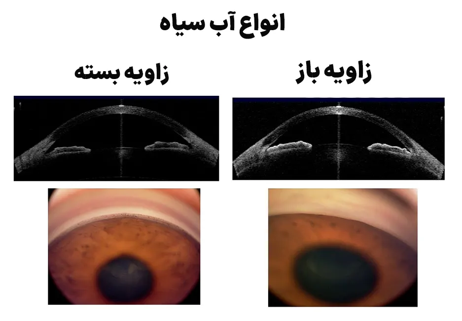انواع آب سیاه