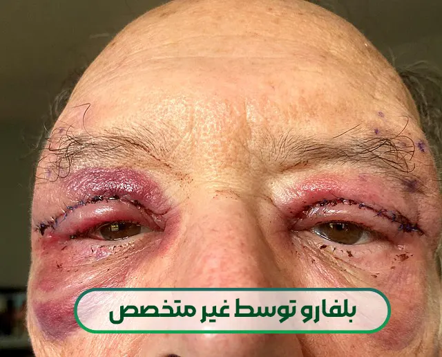 بلفارو توسط غیر متخصص